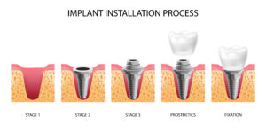 An illustration titled "Implant Installation Process" showing five stages of a dental implant