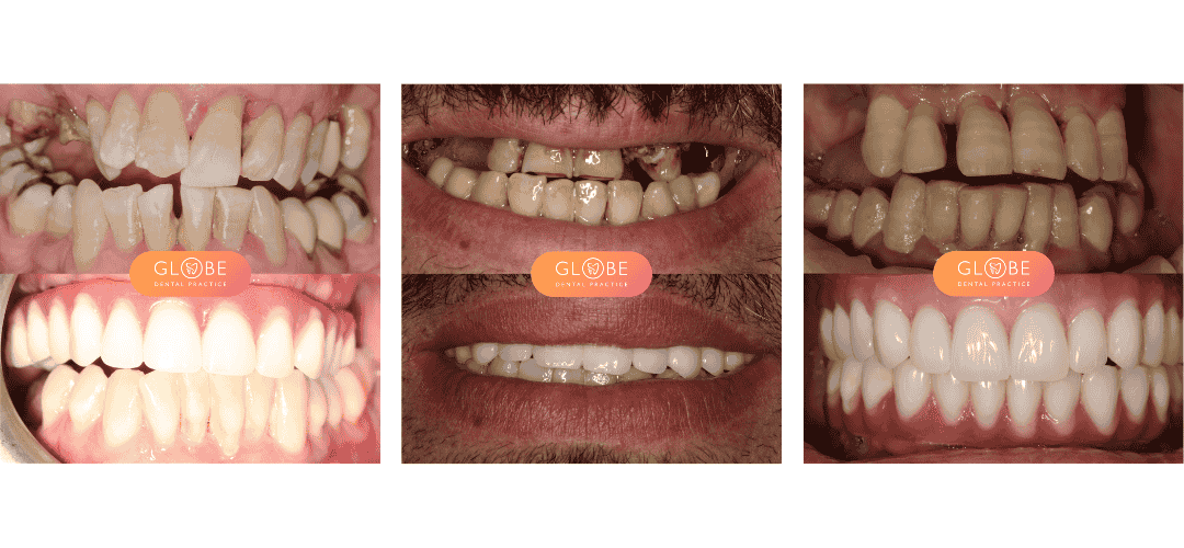 Before and after results of All-on-4 full mouth dental implants completed at Globe Dental Practice Nantwich Cheshire
