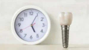 dental implant and clock - how long do dental implants last blog featured image